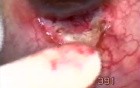 Neovascular glaucoma - operation
