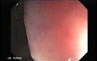 Diffuse Colonic Varices (1 of 4)