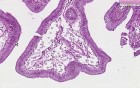 Gallbladder - Cholesterolosis