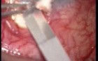 Typical Mini-Trab Procedure 