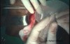 Inguinal Hernia Repair With Prolene Hernia System (PHS)