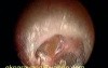 Retracted Tympanic Membrane Moving With Respiration