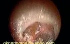 Retracted Tympanic Membrane Moving With Respiration