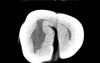 Maxillary Teeth - Root Canal Anatomy