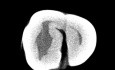 Maxillary Teeth - Root Canal Anatomy
