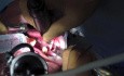 Bone Graft - Ramus Osteotomies And Harvesting Block