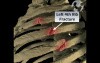 Rib Fractures