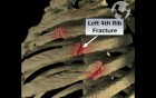 Rib Fractures