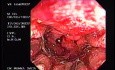 Zollinger- Ellison Syndrome - Gastric Ulcer with Gastrocolic Fistula (20 of 21)