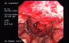 Zollinger- Ellison Syndrome - Gastric Ulcer with Gastrocolic Fistula (20 of 21)