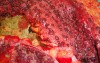 Multiple Rectal Ulcers (85 of 110)