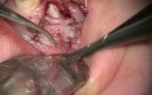Exposure Of Upper Cuspid