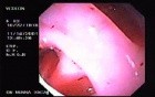 Diverticular Disease - Hemorrhage (10 of 15)