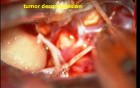 Brain tumor-Trigeminal Schwannoma - Microsurgical Excision