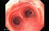 Bronchoscopy