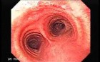 Bronchoscopy