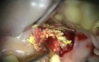 Endo/Perio Microsurgery