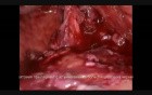Laparoscopic Cholecystectomy in Patient with Gallstones and Liver Cirrhosis 