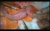 Open Right Hemicolectomy – Technical Principles - Operation No 1 - Part 6