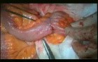 Open Right Hemicolectomy – Technical Principles - Operation No 1 - Part 6