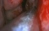 Revision Of The Sinuses - FESS