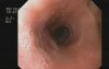 Esophageal Diverticula