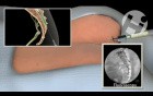 Caudal Procedure
