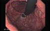 Esophageal Varices and Hiatus Hernia - 93 Year Old Male