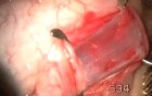 Removal And Tie Low An Extraocular Muscle