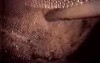 Laparoscopic Ventral Hernia Surgery