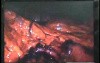Jejunal Gastrointestinal Stromal tumor (GIST) (47 of 86)