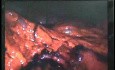 Jejunal Gastrointestinal Stromal tumor (GIST) (47 of 86)
