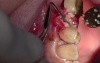 Extraction #13 With Simple Socket Bone Grafting