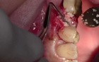 Extraction #13 With Simple Socket Bone Grafting