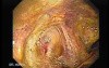 Severe case of Ischemic Colitis (1 of 19)