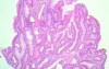 Endoscopic Resection of Giant Tubulo-Villous of the rectum (26 of 35)