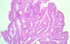 Endoscopic Resection of Giant Tubulo-Villous of the rectum (26 of 35)