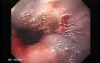 Severe Bleeding of the Upper Digestive System After Two Days of Band Ligation - Coagulation