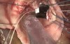Operative Technique of Aortic Valve Replacement