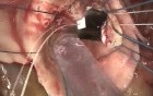 Operative Technique of Aortic Valve Replacement