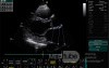 Ostium Secundum Atrial Septal Defect (ASD)