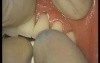 Glass Ionomer Cementation (6/6)