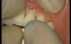 Glass Ionomer Cementation (6/6)