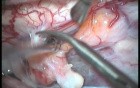Cervical Intramedullary Teratoma - Posterior Approach