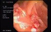 Tubulo - Villous Adenoma - Endoscopy (7 of 28)