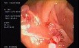 Tubulo - Villous Adenoma - Endoscopy (7 of 28)