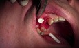 Membrane Application & Bone Fill - Extraction #5 with Socket Bone Grafting - d-PTFE