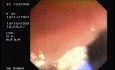 Tubulo - Villous Adenoma - Endoscopy (15 of 28)