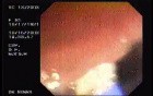 Tubulo - Villous Adenoma - Endoscopy (15 of 28)