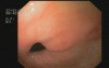 Upper Gastrointestinal Tract Bleeding In Colonoscopy 